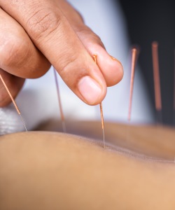 Acupuncture Near Me in Newtown, PA